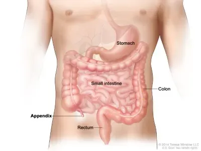Appendix Surgery in Ahmedabad