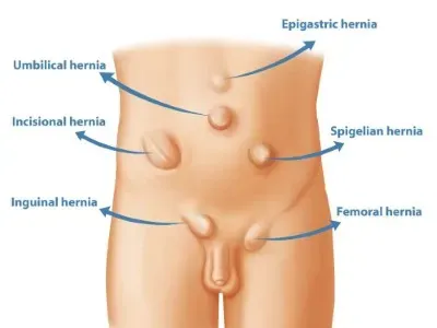 Hernia Surgery in Ahmedabad