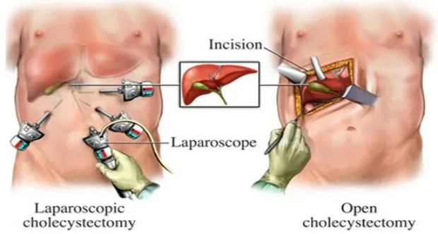 Types of Gall Bladder Stone  Surgery 